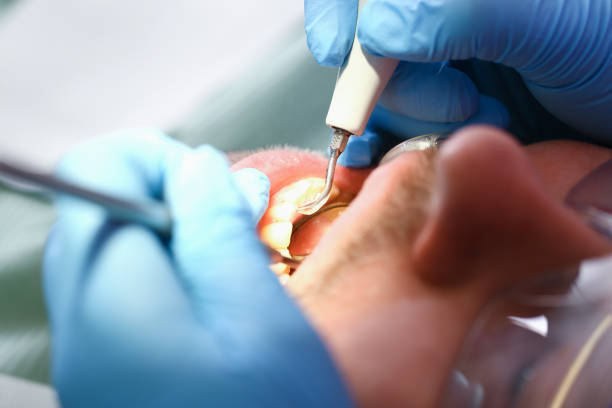 Best Emergency Dentist for Knocked-Out Tooth in Richville, OH